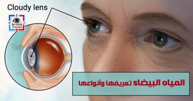 cataract definition