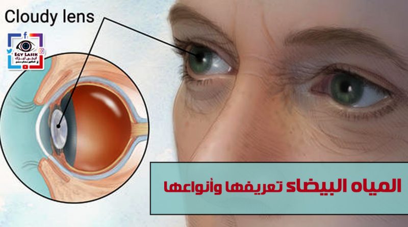 cataract definition