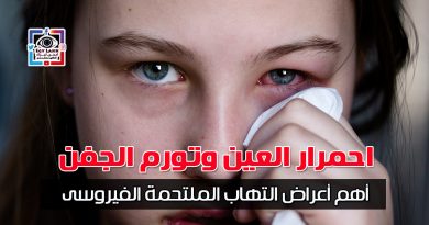 conjunctivitis