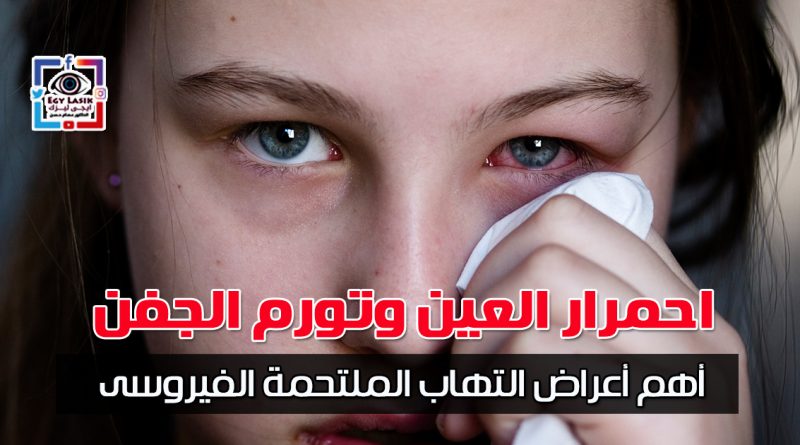 conjunctivitis