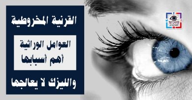 keratoconus-symptoms