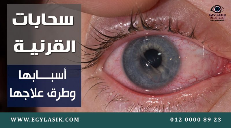 Corneal zippers