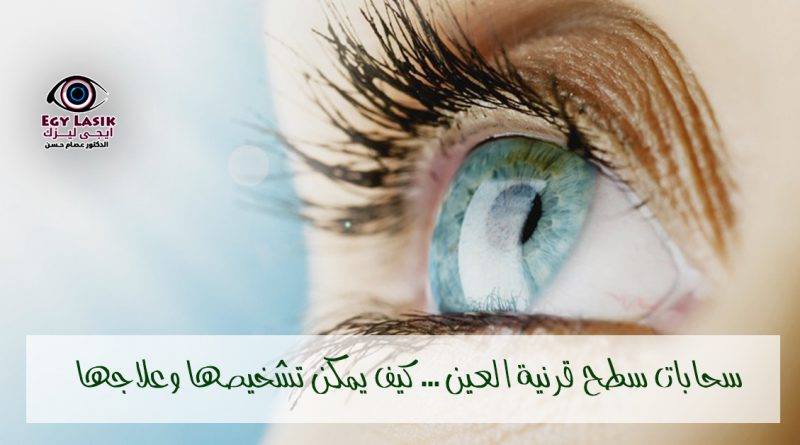 corneal opacity